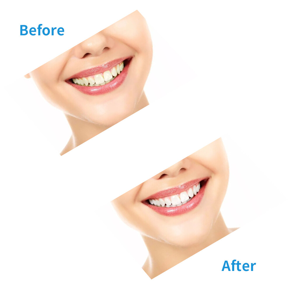 Dental Gingival Gel Dam Barrier Gum Protector Syringe Teeth Whitening Gel Kit