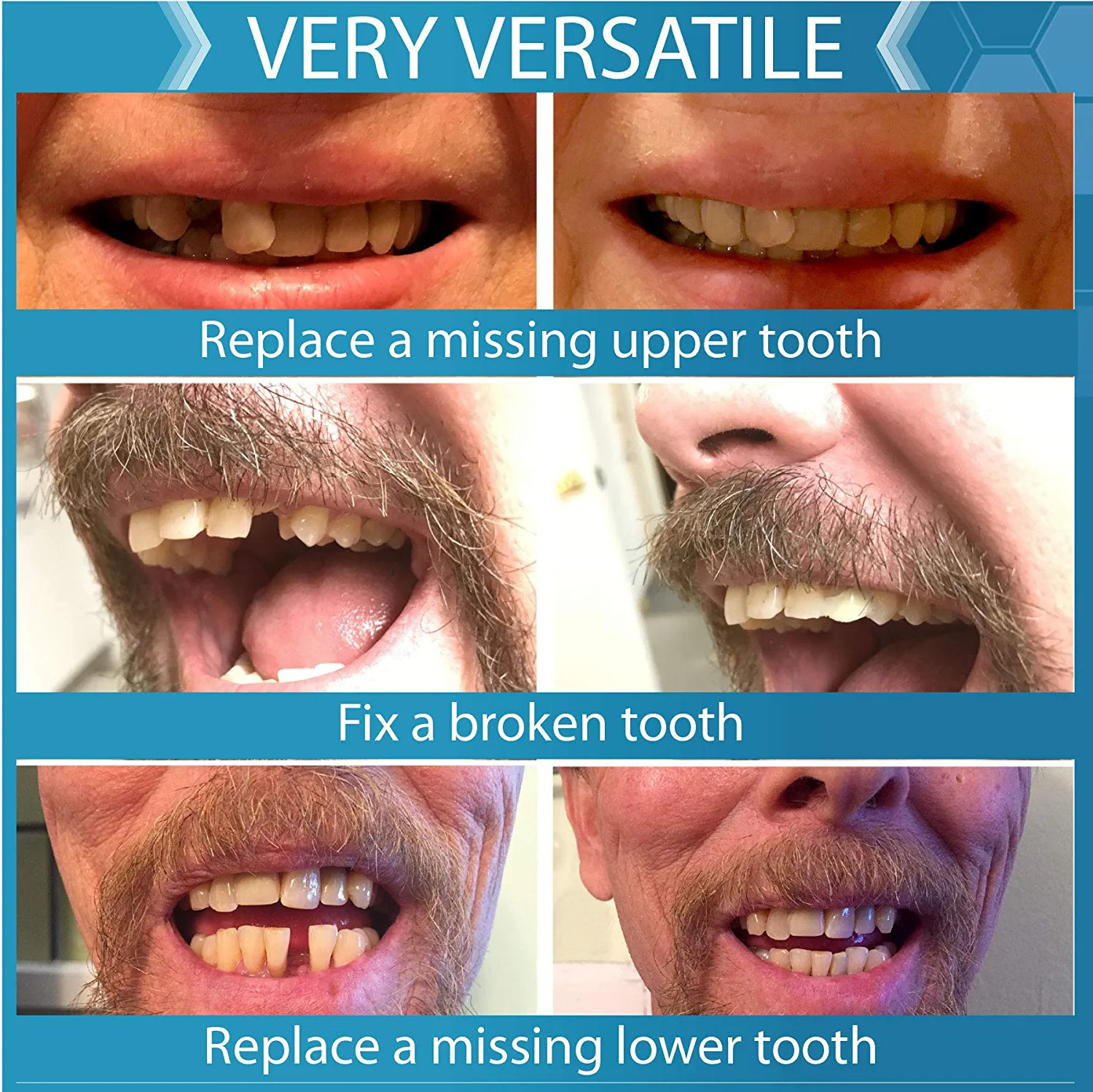 Instant Smile 40 Assorted Temporary Tooth Kit Deluxe 4 Shades Replacement Kit