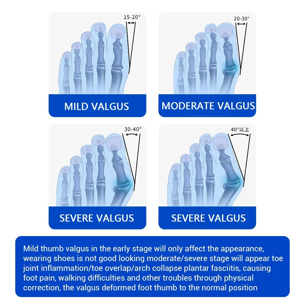 Bunion Fix Toe Valgus Corrector Adjustable Orthosis Women Men Splints