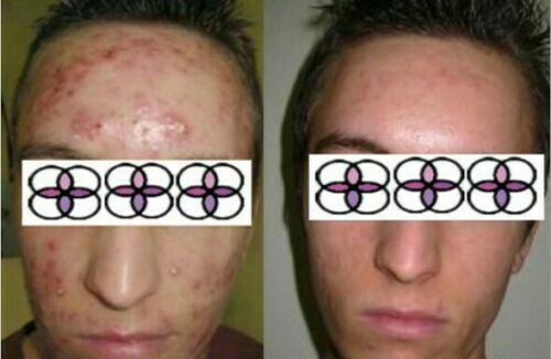 10-20-30-40-50-60-70% Glycolic Acid Night Cream 2oz/ 60ml Aging/Acne/scar