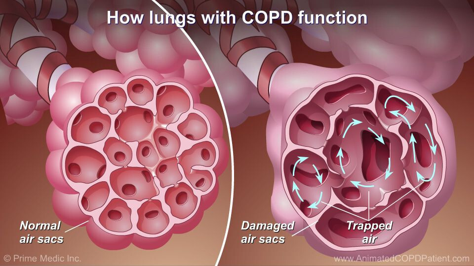 Serious Support for Asthma, Bronchitis, Emphysema, COPD – Opens Lung Airways.