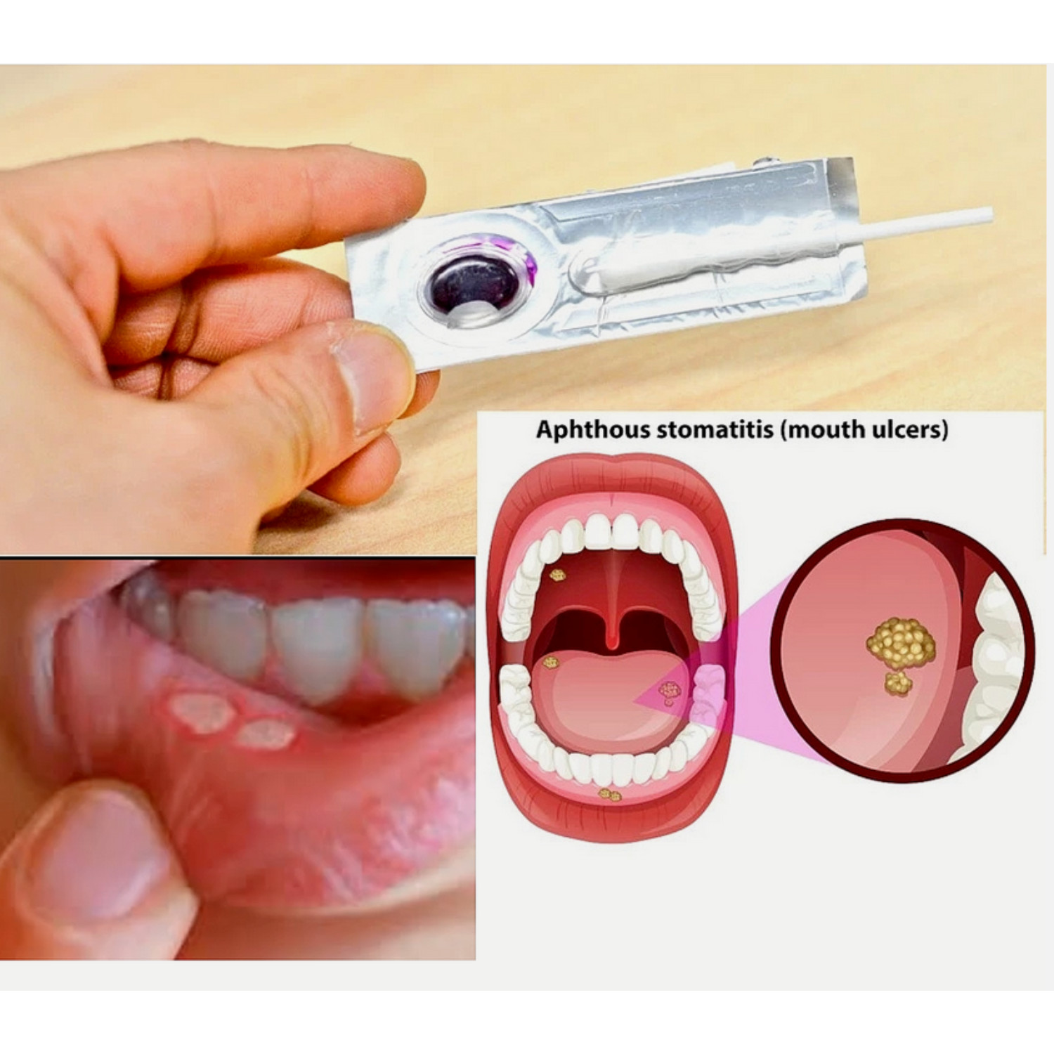 3 PCS Oralmedic Mouth Ulcer Gel 1 Treatment Fast Pain Relief Free Shipping