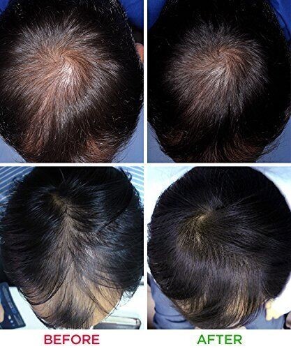 iRESTORE Professional 282 Laser Hair Growth System – Reconditioned
