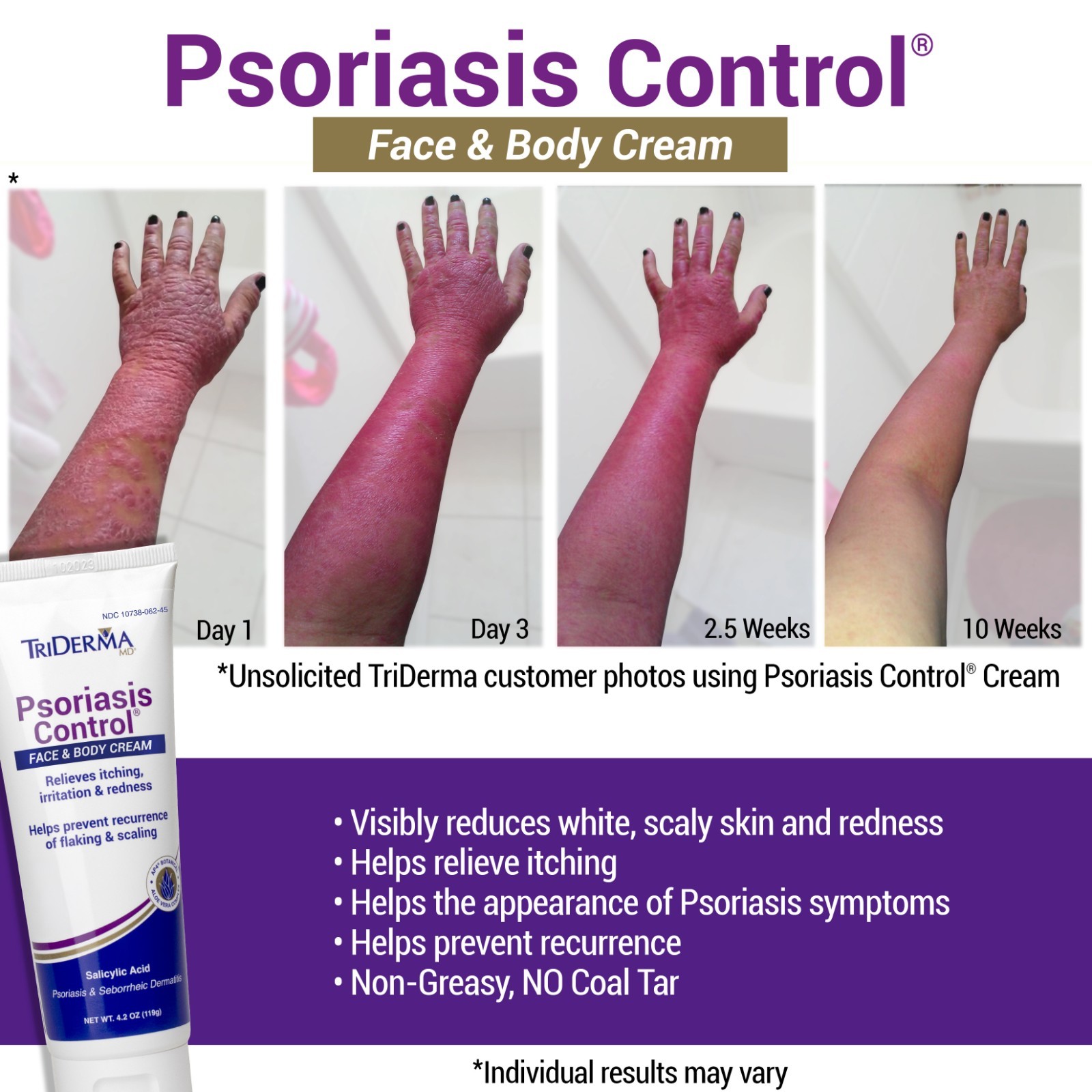 TriDerma Psoriasis Control Face and Body Cream, Cortisone-Free 4.2 Ounces