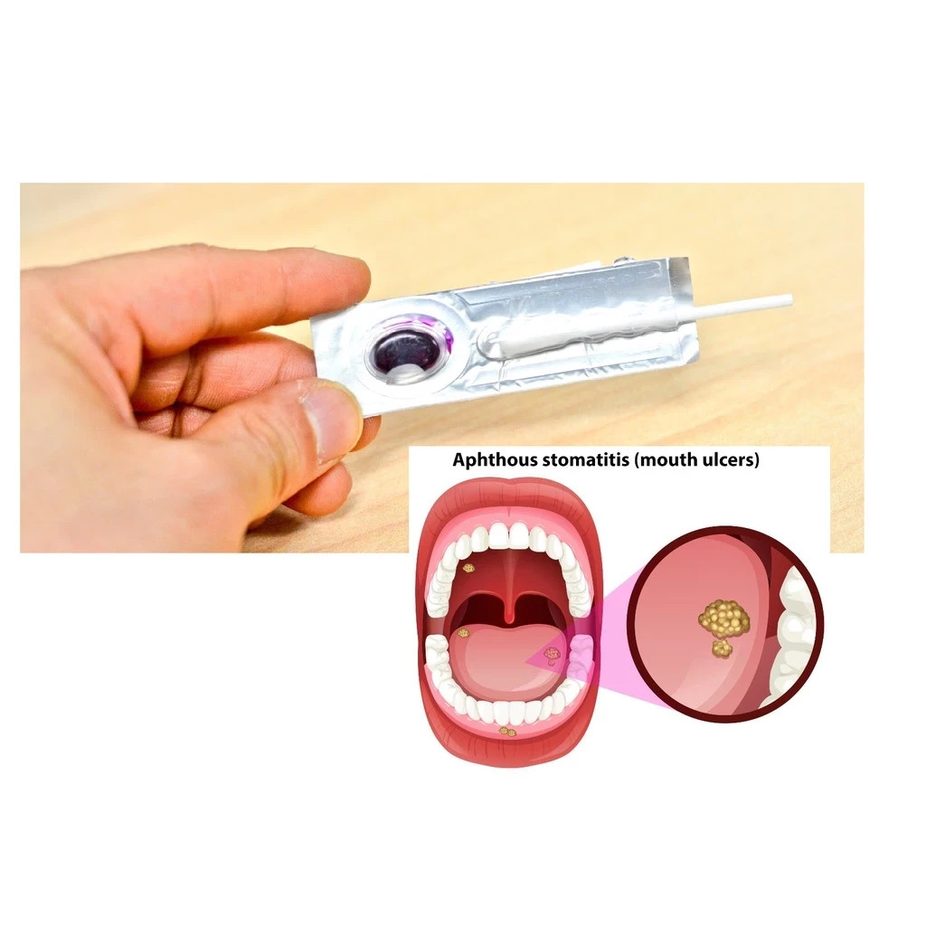 (Pack of 3) Oralmedic Mouth Ulcer Gel 1 Treatment Fast Pain Relief Made in USA