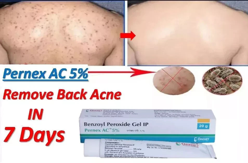 Benzoyl Peroxide Gel for remove back Acne & black spots 20 gm pack of 2