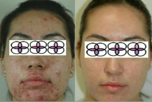 10-20-30-40-50-60-70% Glycolic Acid Night Cream 2oz/ 60ml Aging/Acne/scar