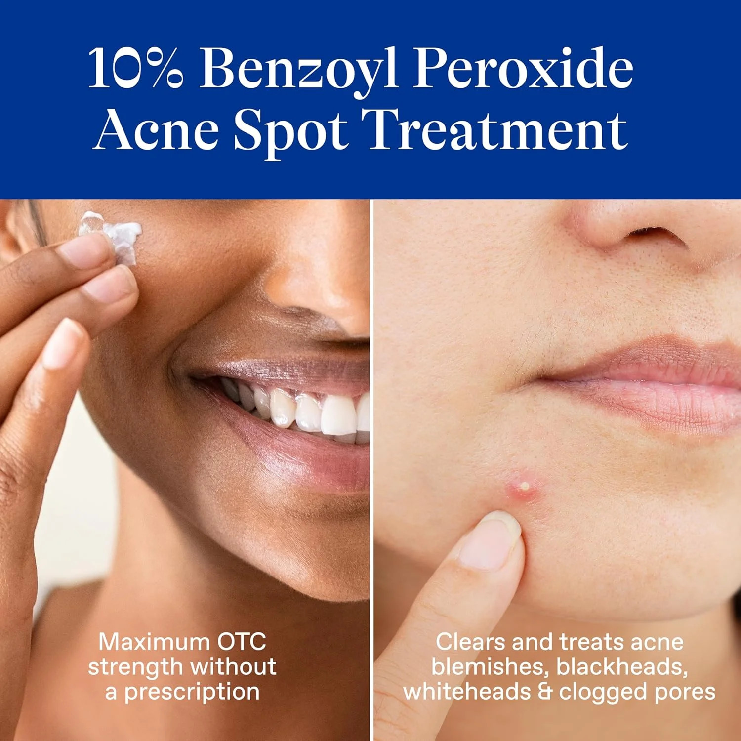 Differin Acne Spot Treatment with 10% Benzoyl Peroxide, Maximum Strength OTC Acn