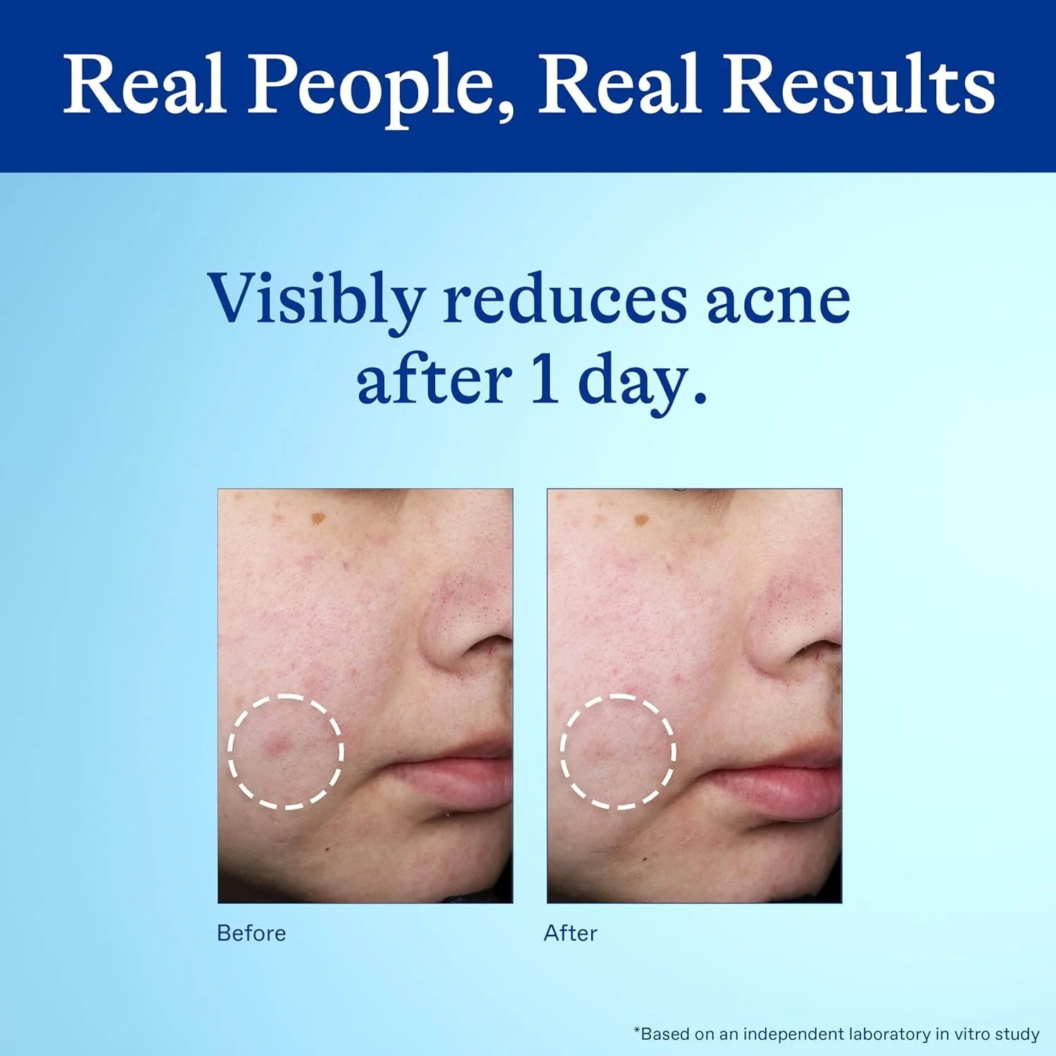 Differin Acne Spot Treatment with 10% Benzoyl Peroxide, Maximum Strength OTC Acn