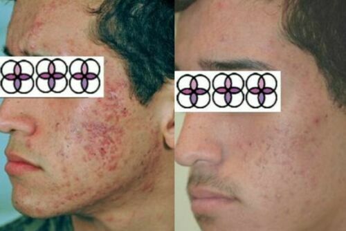10-20-30-40-50-60-70% Glycolic Acid Night Cream 2oz/ 60ml Aging/Acne/scar