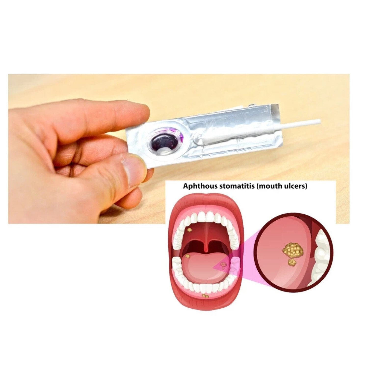 3 PCS Oralmedic Mouth Ulcer Gel 1 Treatment Fast Pain Relief Free Shipping