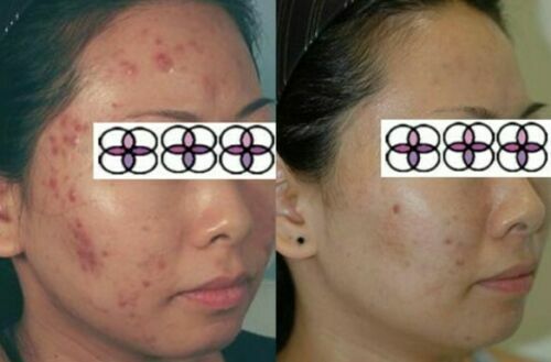 10-20-30-40-50-60-70% Glycolic Acid Night Cream 2oz/ 60ml Aging/Acne/scar