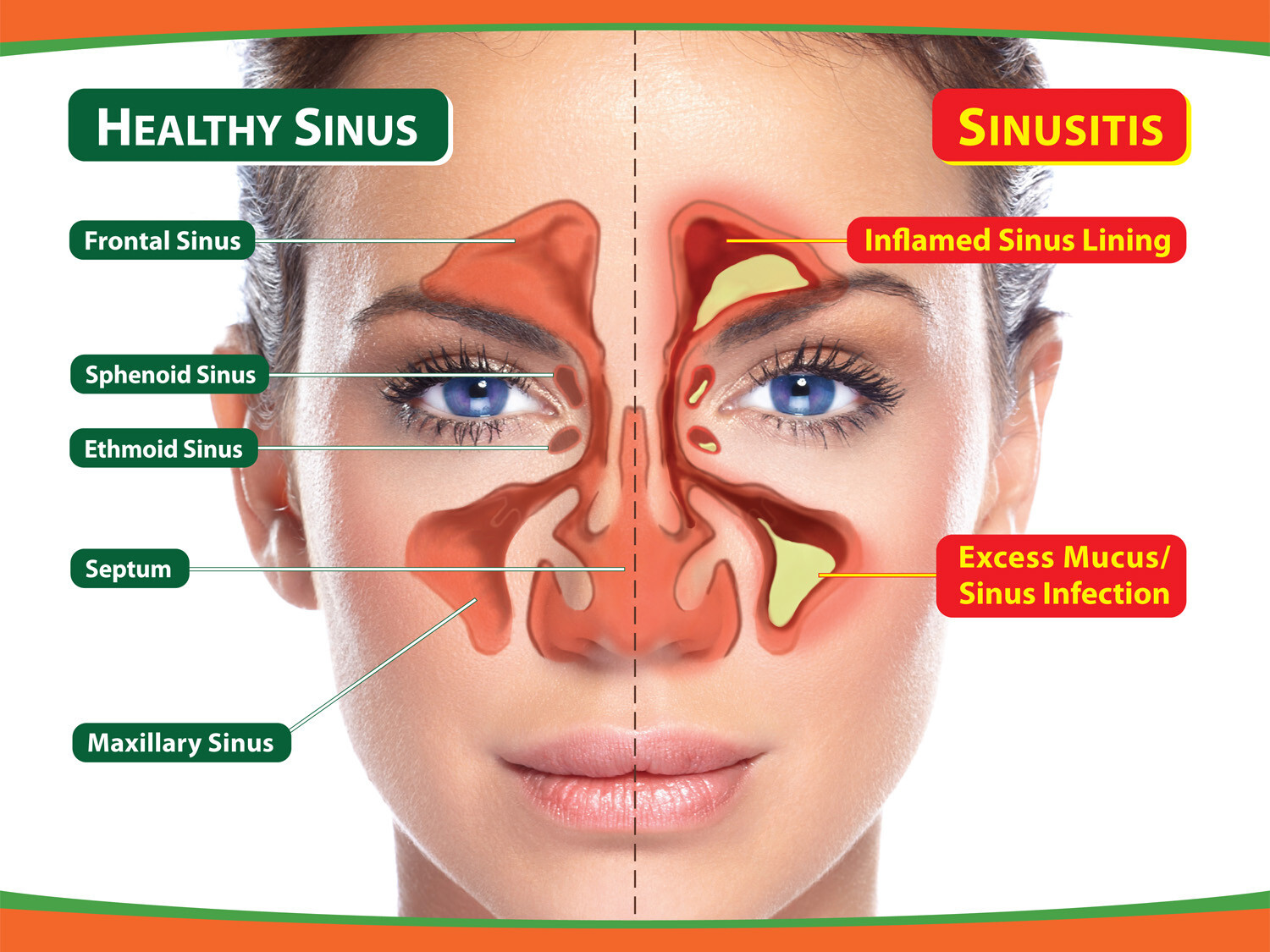 Clear Sinusitis, Controlling Allergy and Sinus Infection The Natural Way.