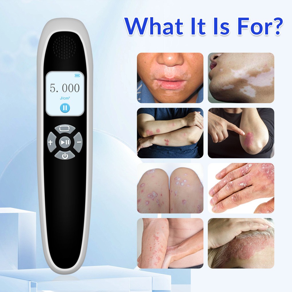 308nm Narrowband UVB Light Device 9 Diodes 55mW/cm2 Handheld Home Skin Care Use