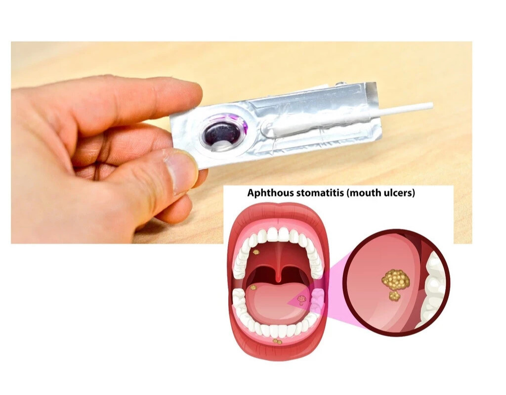 (Pack of 6 ) Oralmedic Mouth Ulcer Gel 1 Treatment Fast Pain Relief Made in USA