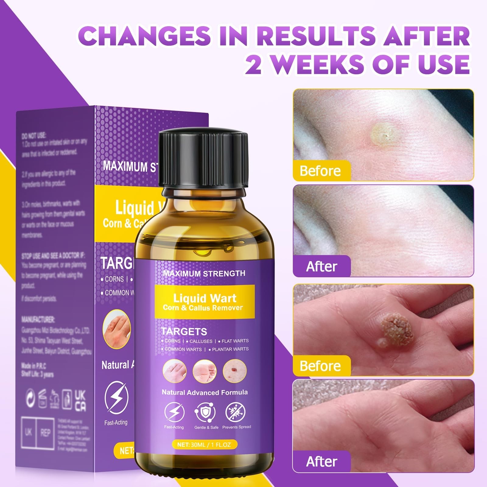 Effective Wart Remover Liquid – Fast Acting Treatment for Plantar, Common & Flat