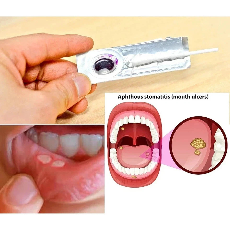 Oralmedic Mouth Ulcer Gel 1 Treatment Fast Pain Relief