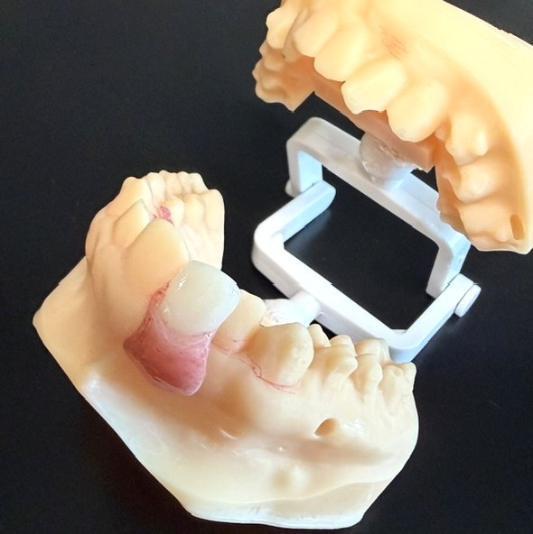 Acrylic Denture Flipper – Custom Fitted