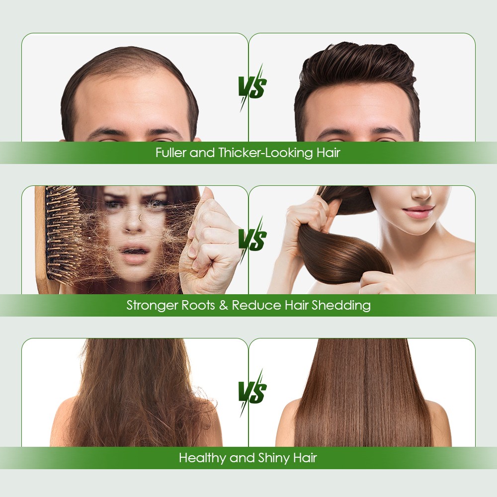 160/8x Microneedle Infusion Hair Regrowth System Advanced Hair Growth Treatment