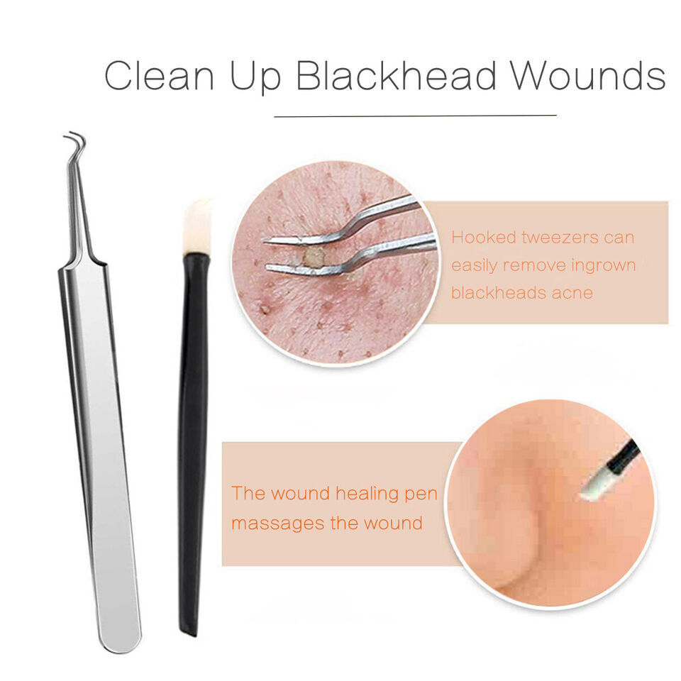 Portable Acne Removal Kit Easy to Use Face Cleansing Blackhead Extraction Tool