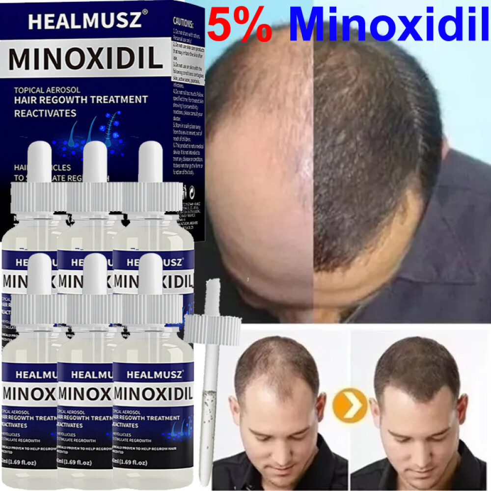 6PCS MINOXIDIL 5% EXTRA STRENGTH HAIR REGROWTH TREATMENT FOR MEN 6 MONTHS SUPPLY