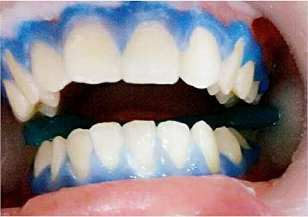 Dental Gingival Gel Dam Barrier Gum Protector Syringe Teeth Whitening Gel Kit