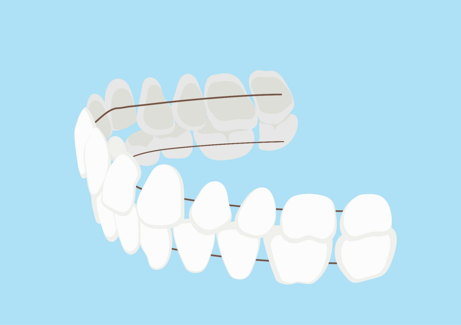 DIY Dentures – Preformed Resin Teeth (upper and lower)