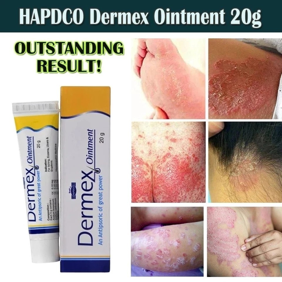 Dermatitis Cream, Eczema Cream, Fast-Acting Itchy Skin Relief, Ea…. NEW BOX