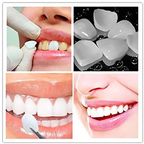 Dental Temporary Crown Veneers for Anterior Front Teeth Whitening 70Pcs