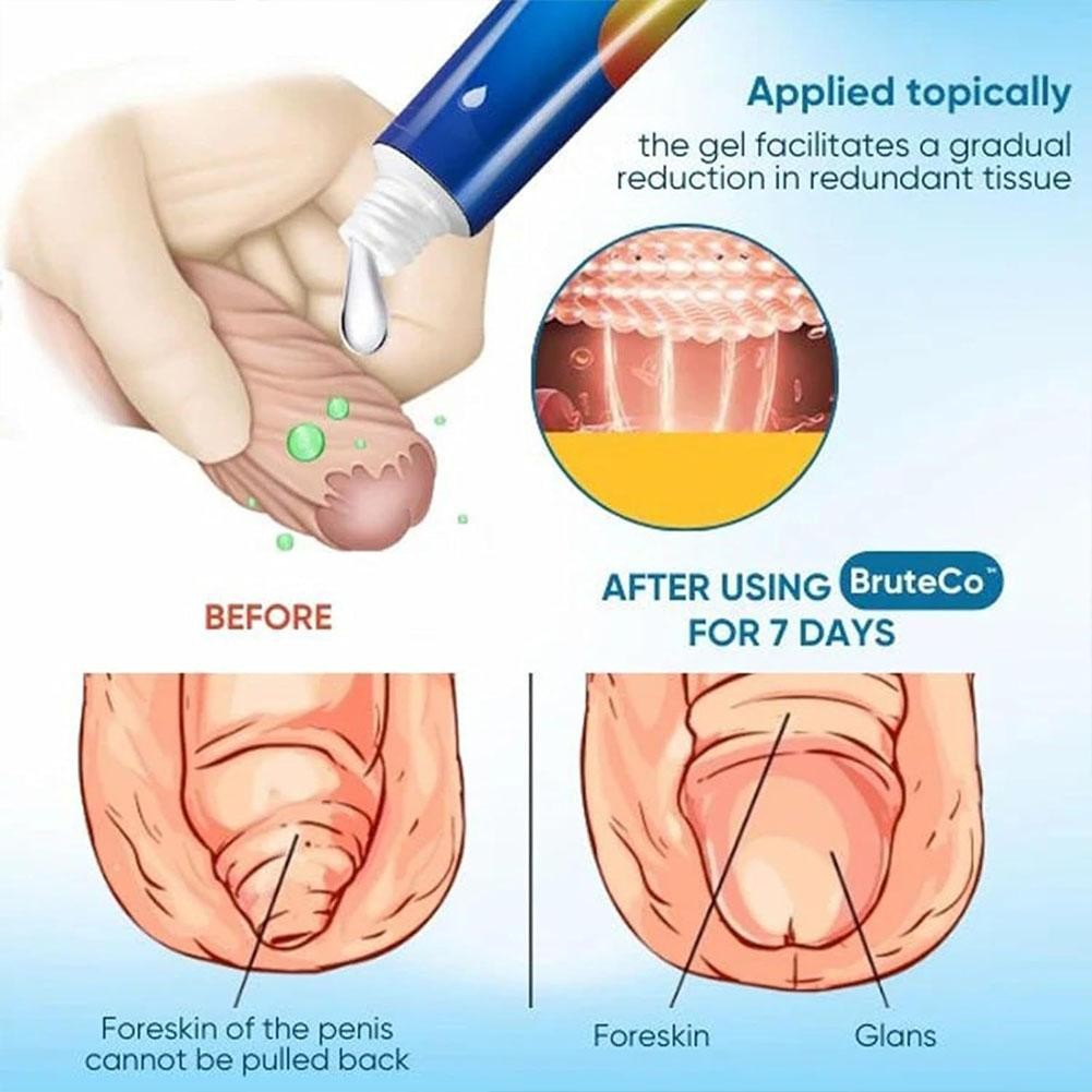 Prepuce Corrector Gel, Professional Redundant Prepuce Gel Corrector