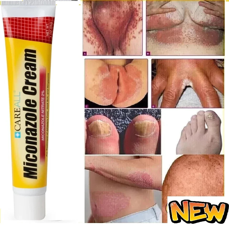 Crema Pomada para Los Hongos En La Piel Pies Brazos Genitales Manos Cara Eficaz