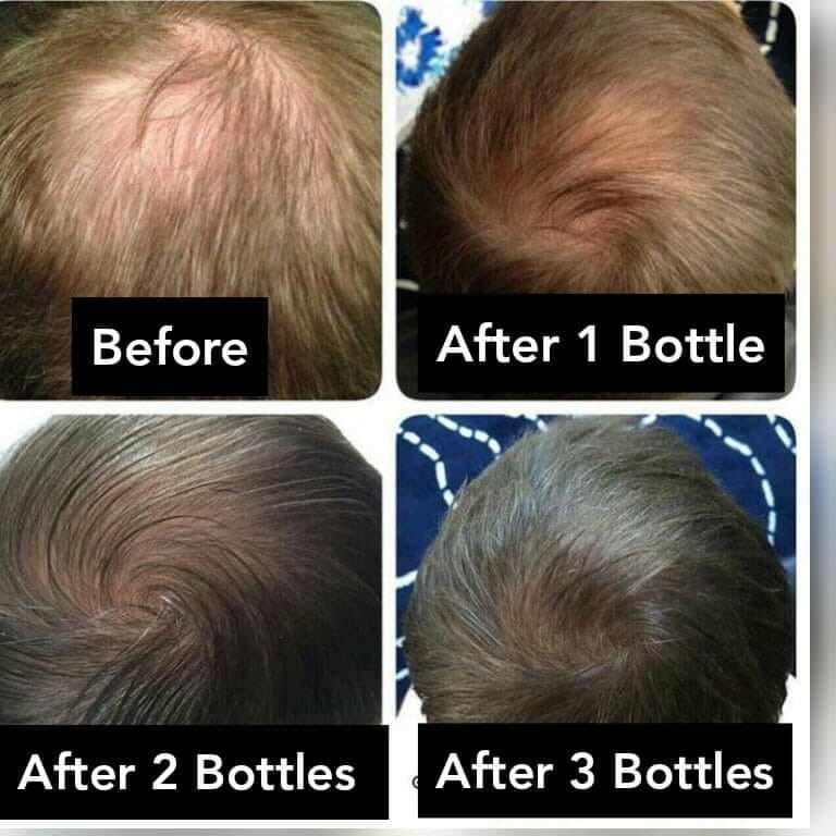 100% Original authentic Neo hair Lotion X 5 ONLY$225.90. 