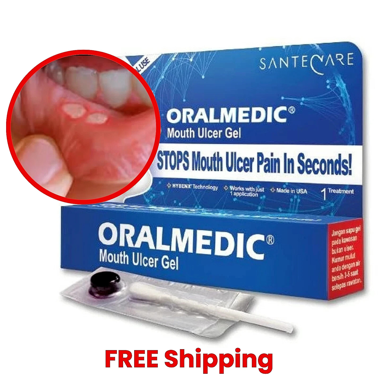 (Pack of 3) Oralmedic Mouth Ulcer Gel 1 Treatment Fast Pain Relief Made in USA