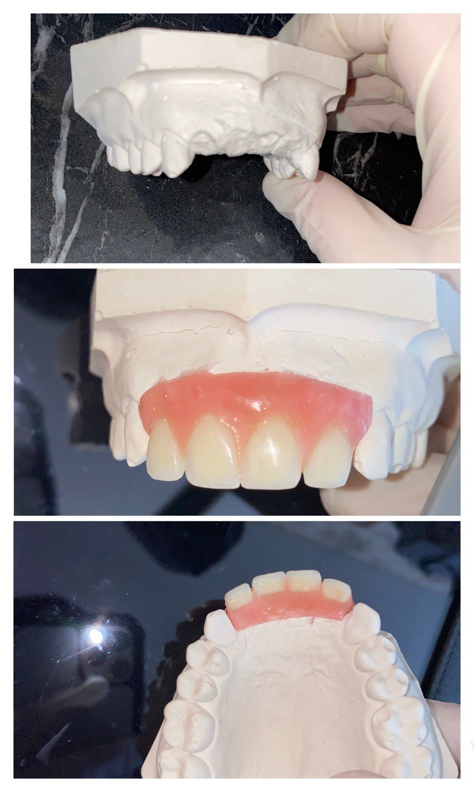 Partial Denture Kit Make Your Own Custom Denture Affordable Temporary Teeth A2