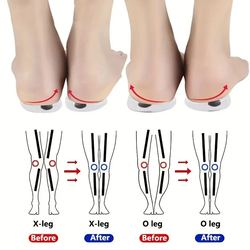 Orthopedic Pair 1 Insole for OX Leg Correction Gel Massage Support Shoe Pad