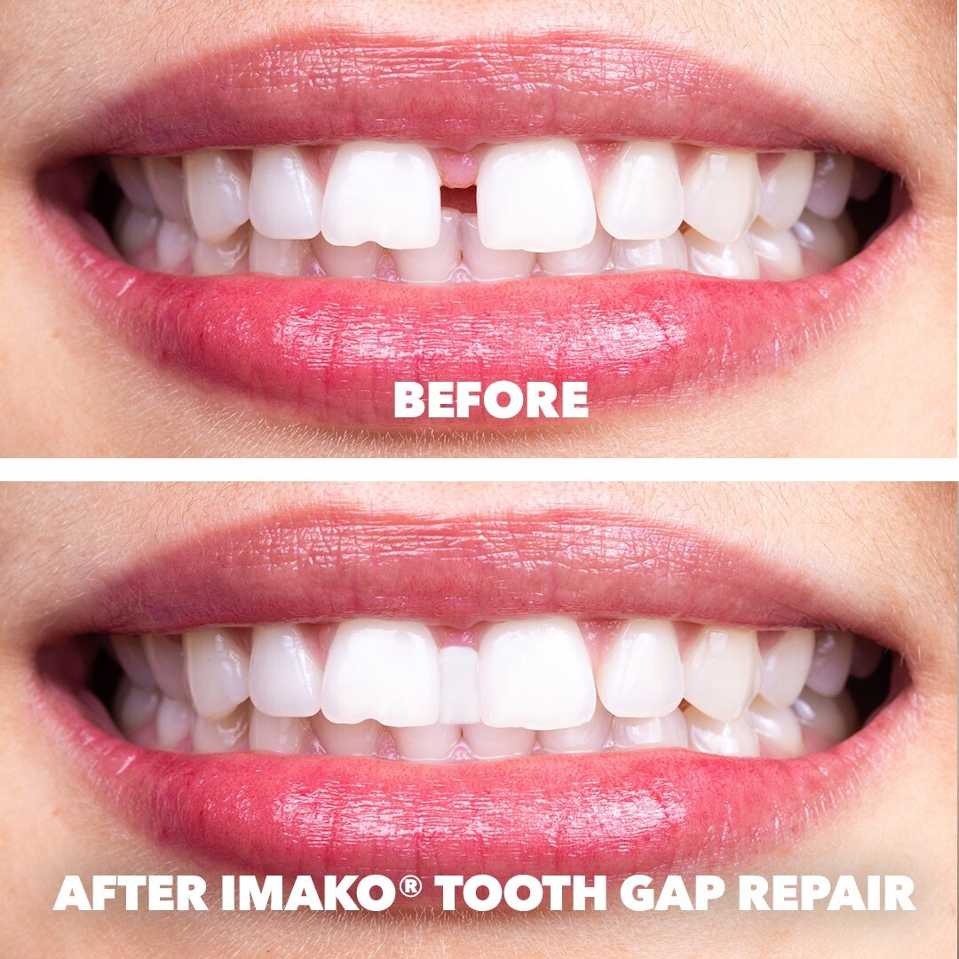 Imako® Tooth Tinted Plastic – Temporary Tooth – Fix Chipped Teeth, Gaps in Teeth