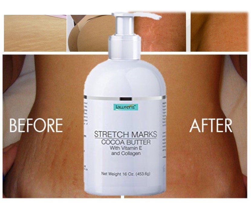 Best Scar Removal-Cream forOld-Scars Stretch Mark Removal Cream for Men & women