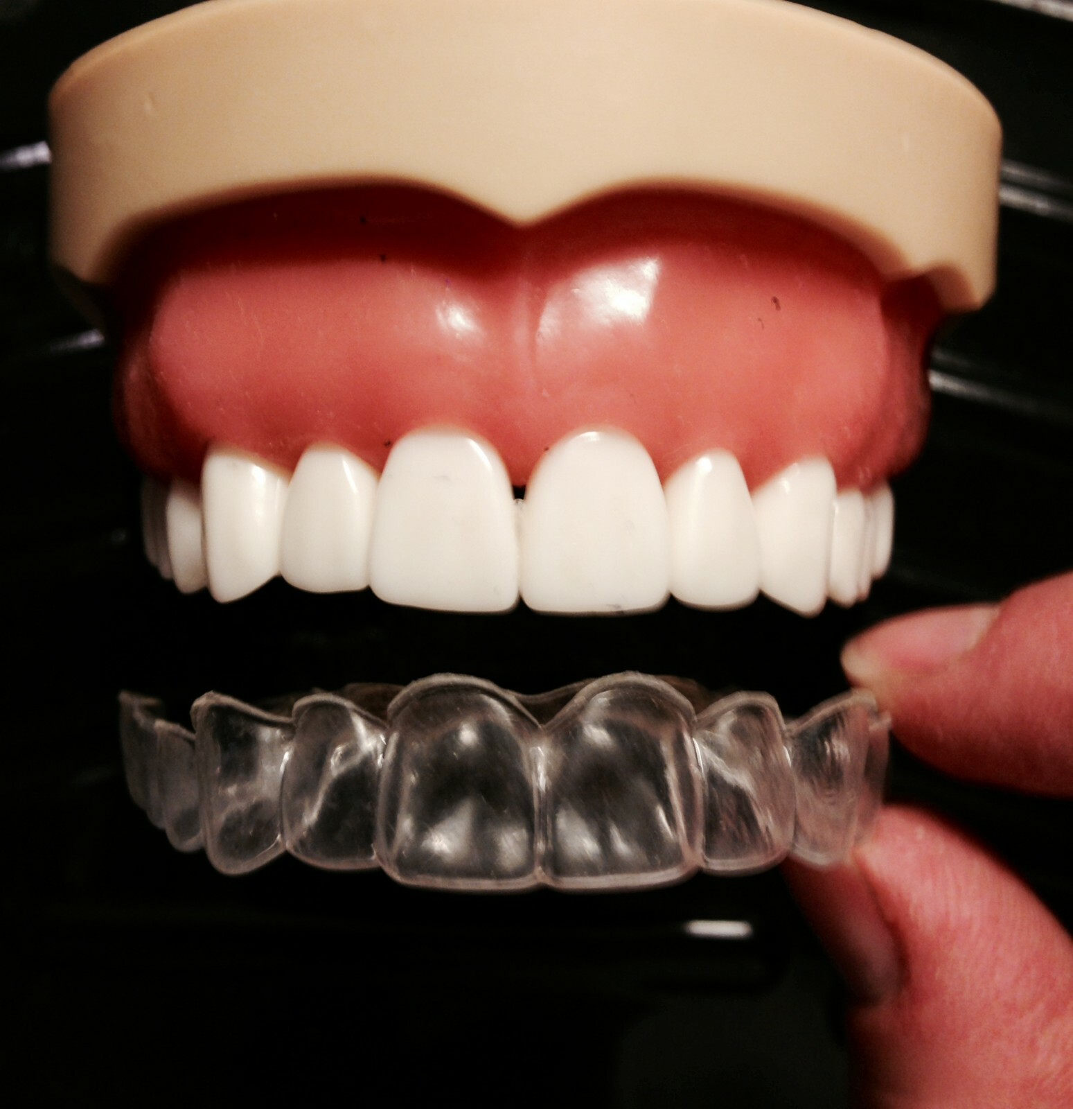 Custom Dental Retainer Set – THICKER TYPE-1.5mm – Double layered- USA Dental Lab