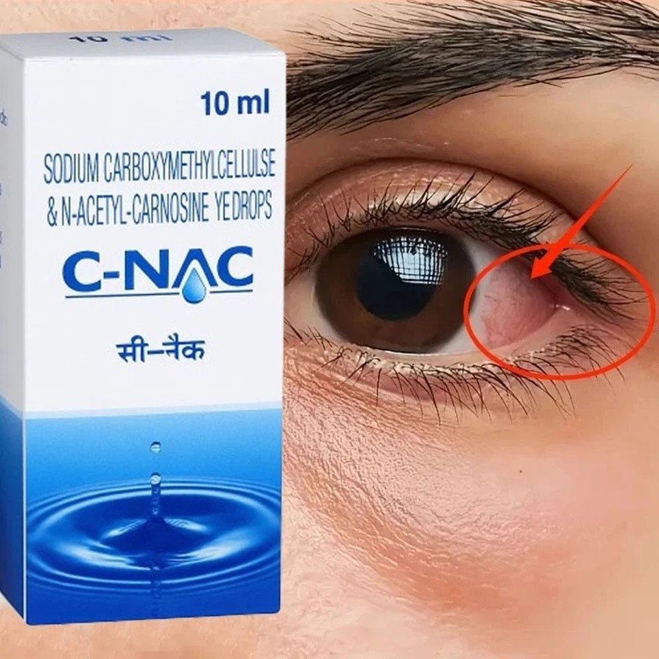 Cataract Eye Drops – Glaucoma, Non Carnosine (NAC), Can Cataracts – SELECT PACK