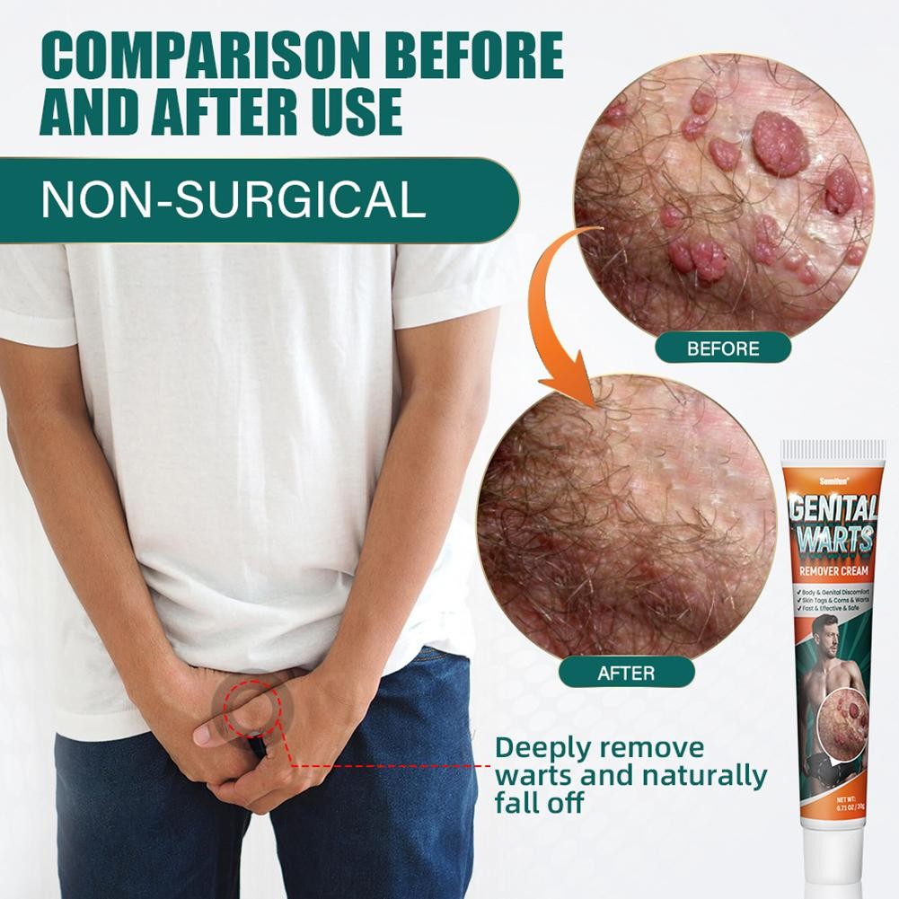 Genital Skinside Remover & Body Cream Genital Discomfort, Warts Tags A4H3