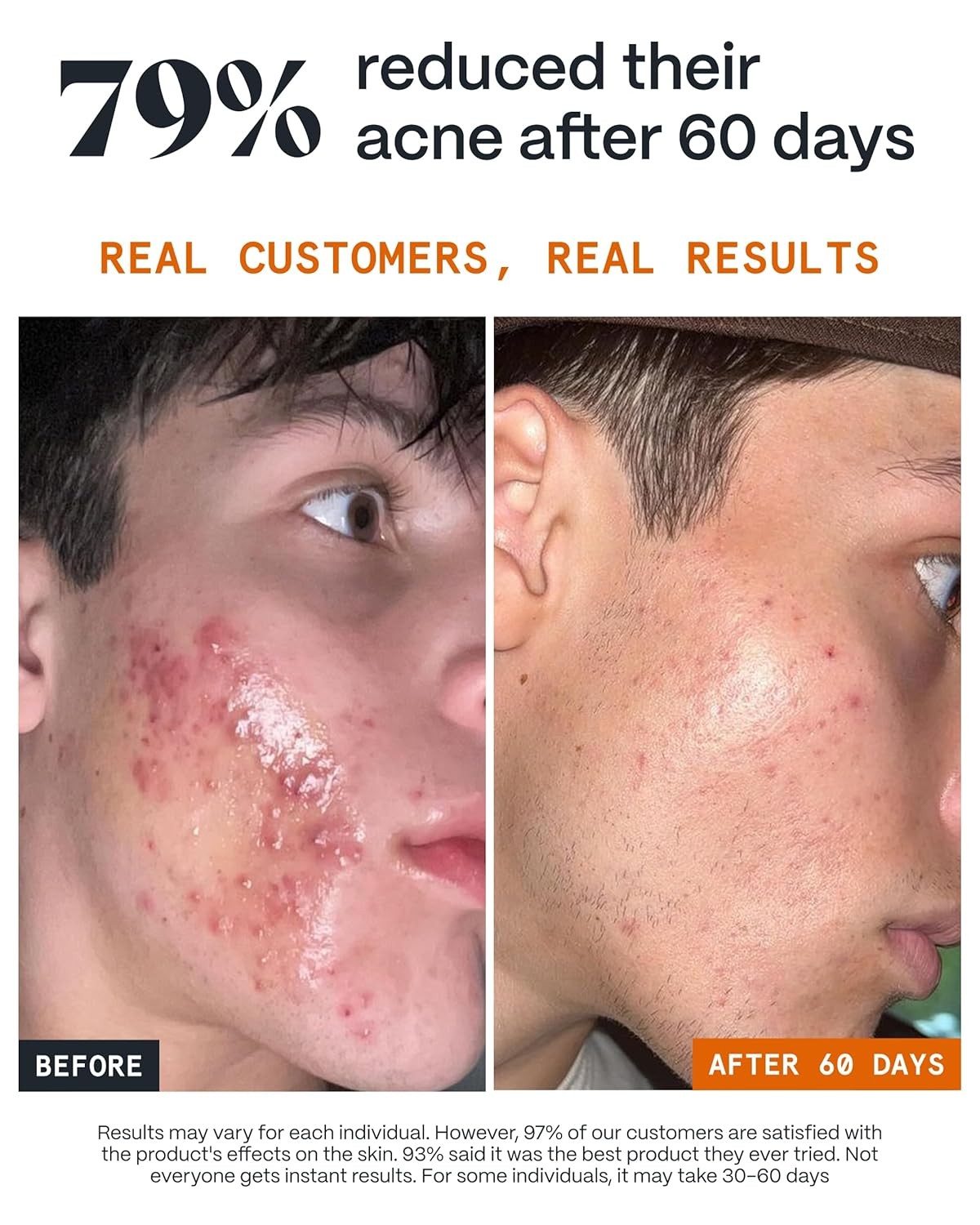 3-Step Acne Kit for Fast Results with Arctic Herbs & Beeswax