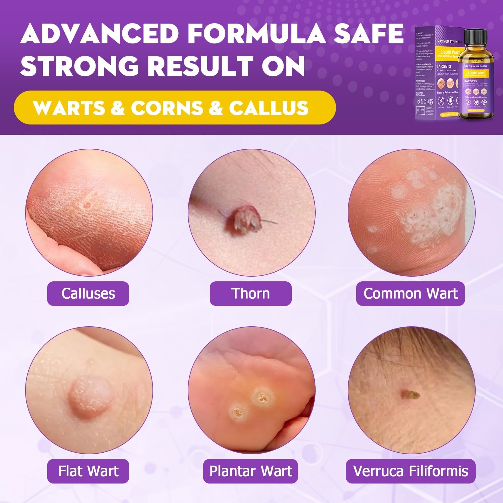 Effective Wart Remover Liquid – Fast Acting Treatment for Plantar, Common & Flat