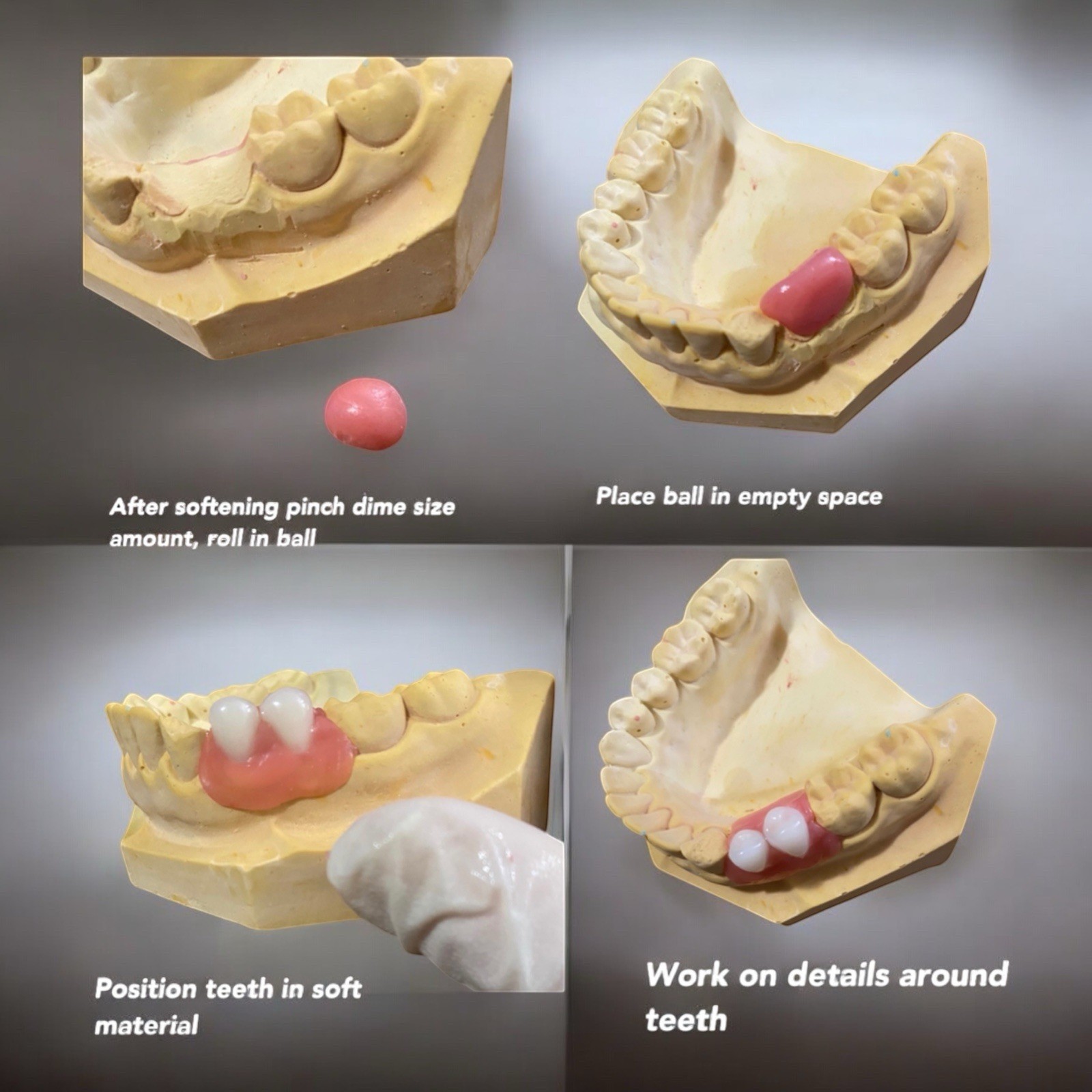 Partial Denture Kit Make Your Own Custom Denture Affordable Temporary Teeth A2